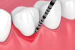 gum pocket