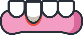 Root Exposure / Soft Tissue Grafting Icon
